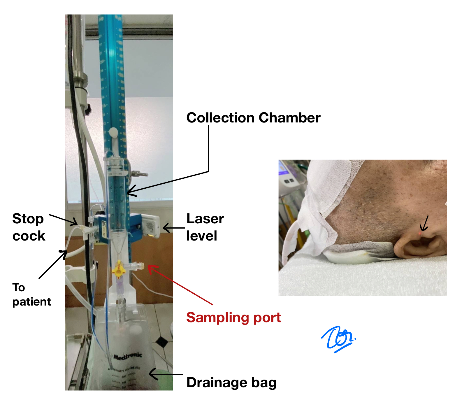 ระบบ ventriculostomy แบบ commercial set แสดงตำแหน่ง stopcock, collection chamber, laser level, sampling port และ drainage bag