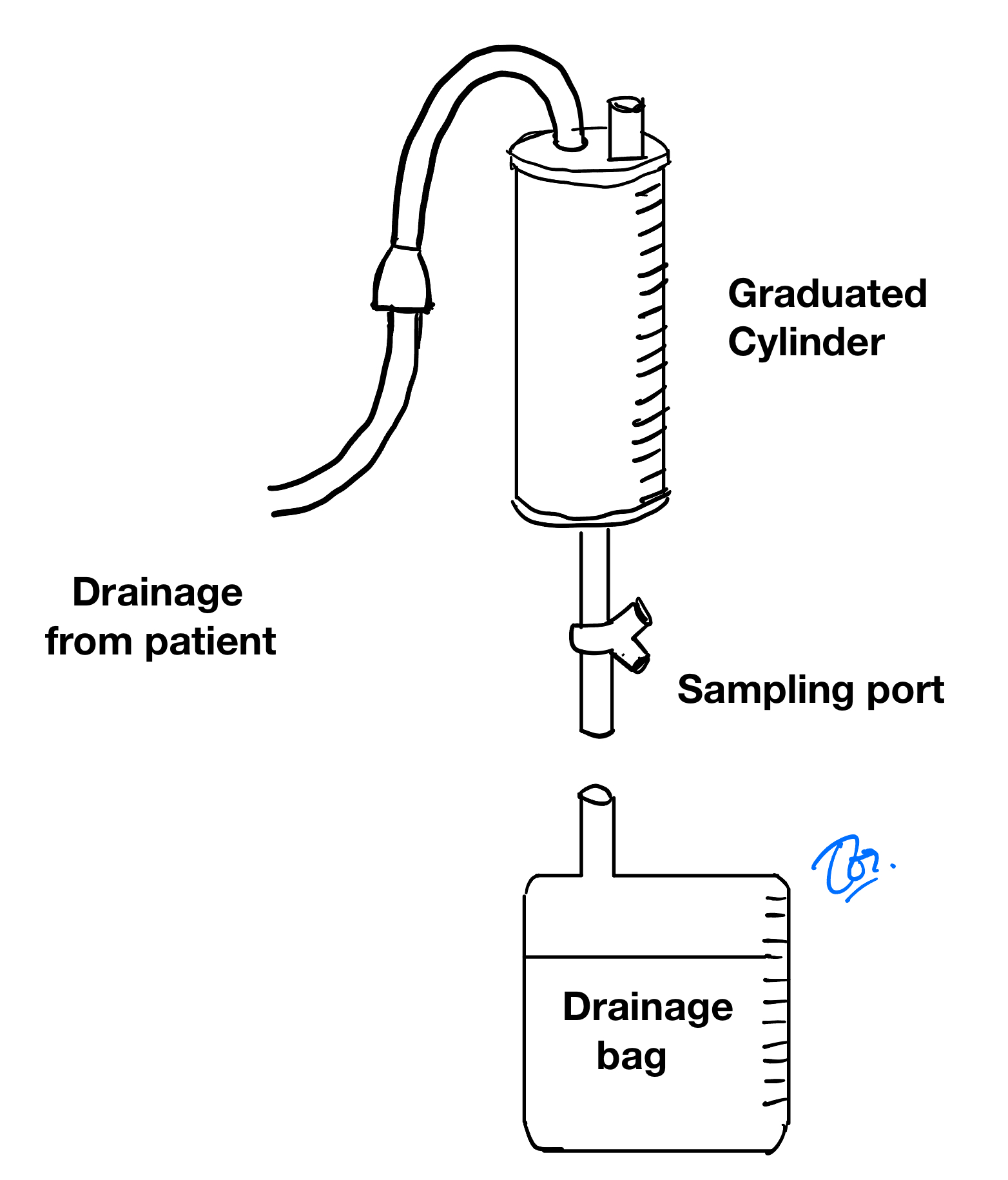 ระบบ ventriculostomy แบบ improvised extension tube แสดงตำแหน่ง graduated cylinder, sampling port และ drainage bag