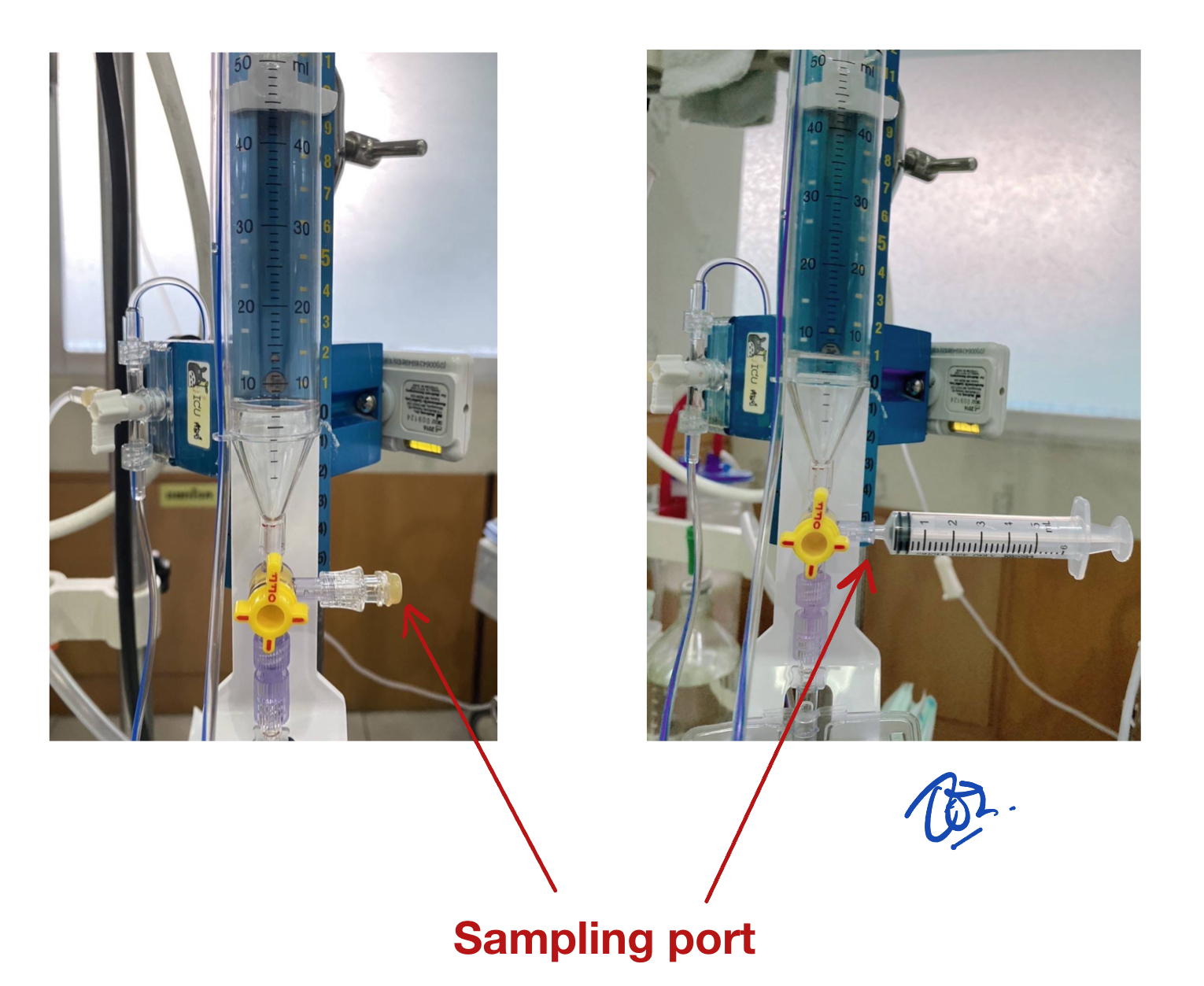 ตำแหน่ง sampling port บนระบบ ventriculostomy สำหรับเก็บ CSF และให้ยาผ่าน syringe